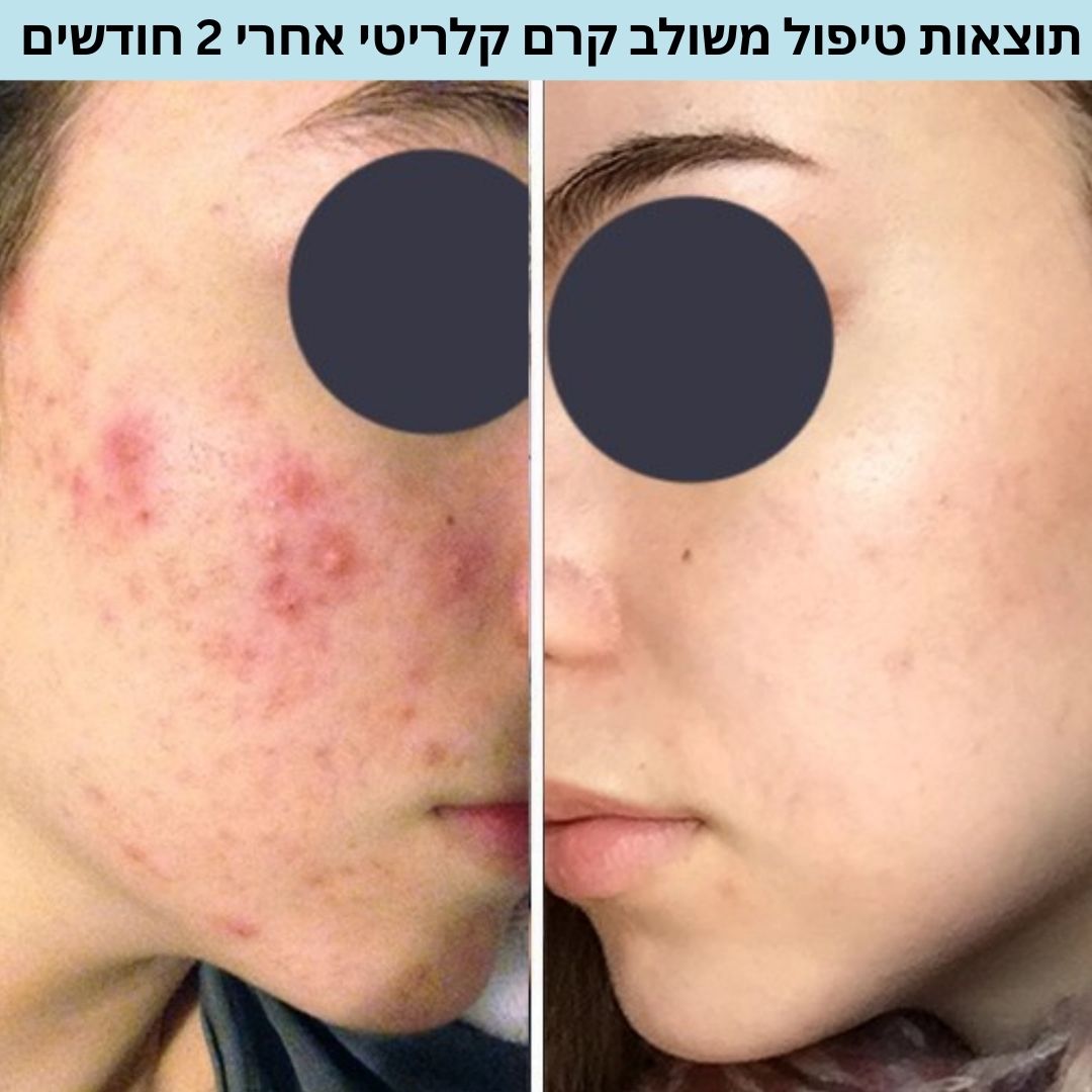 ⁦ערכת טיפול באקנה והבהרה⁩ – תמונה ⁦4⁩
