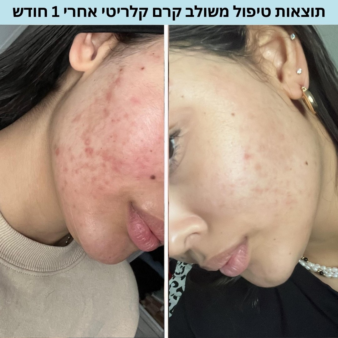 ⁦ערכת טיפול באקנה והבהרה⁩ – תמונה ⁦3⁩